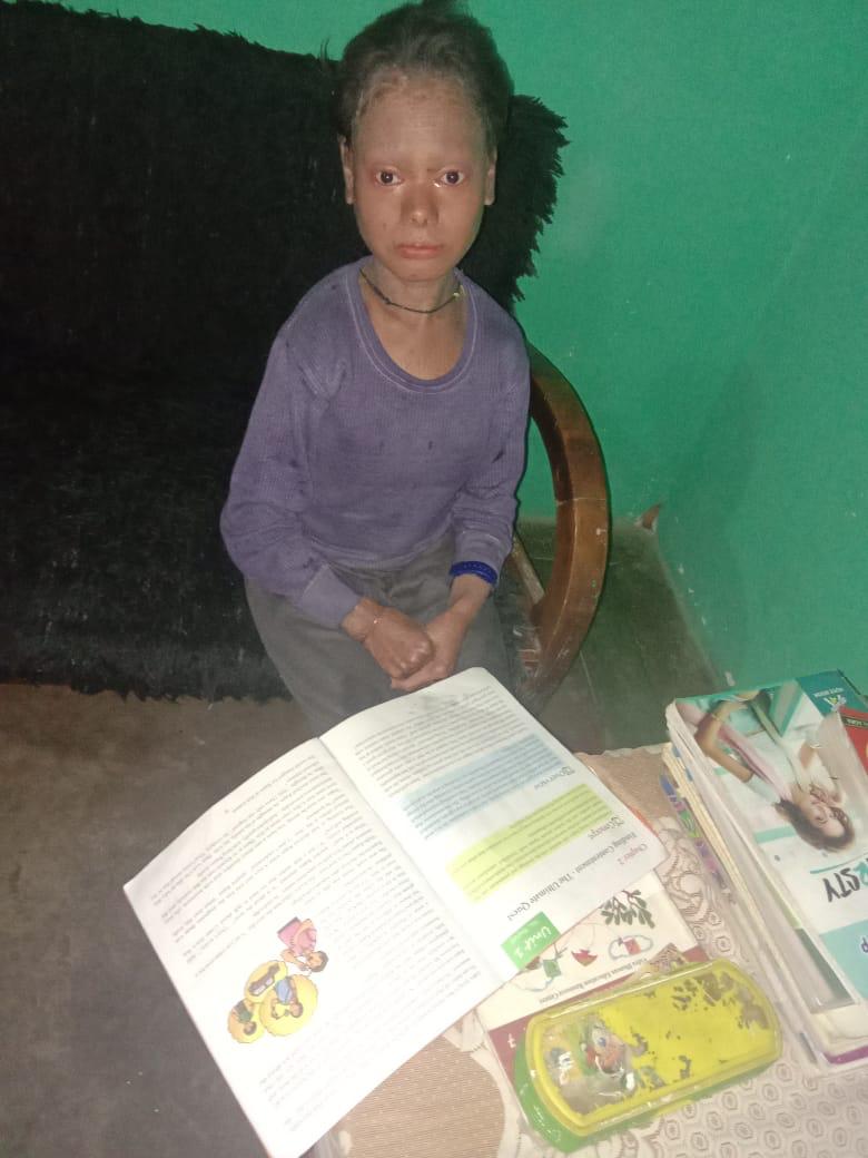 Shalini Yadav sitting with her school books after completing her skin treatment.